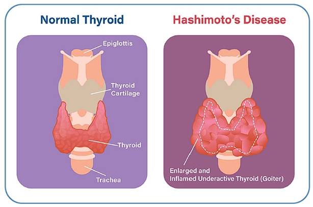 Hashimoto's Thyroiditis