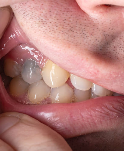 What if the tooth under a crown is black