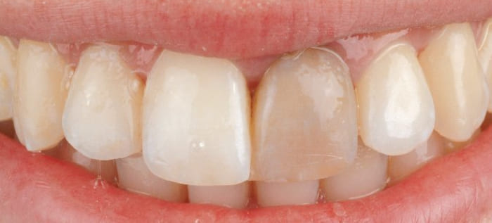 How is a black tooth under a crown treated