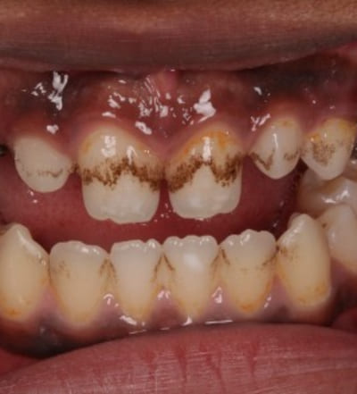 Internal endogenous tooth stains