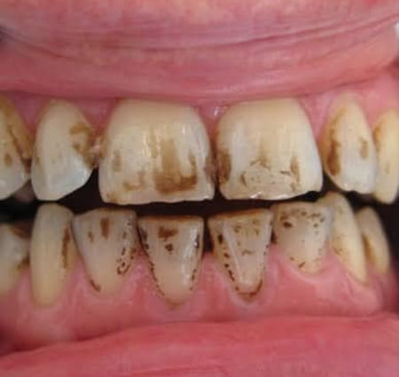 Intrinsic and extrinsic staining why do teeth stain