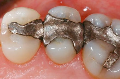 Old metal fillings
