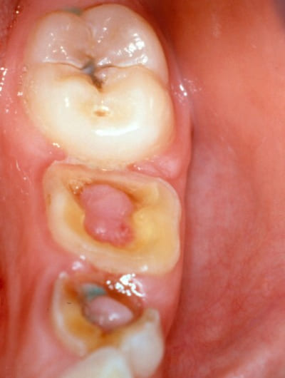 Pulpitis