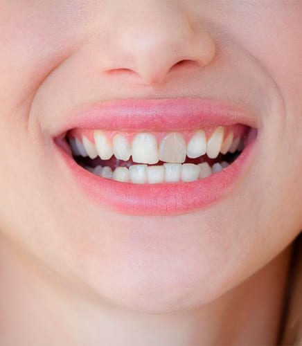 Should a tooth be black under a crown