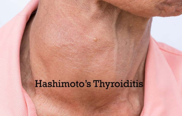 The Case of Hashimoto's Disease, Can hypothyroidism disappear without medication