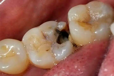 Tooth decay and deep damage