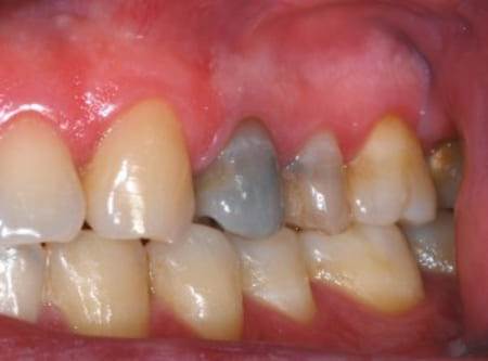 What happens to a tooth that has had root canal treatment