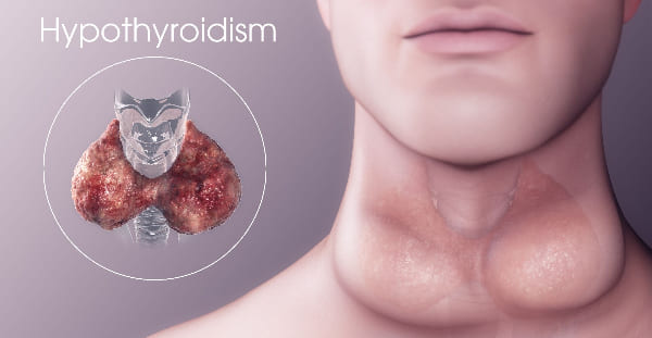 What is hypothyroidism