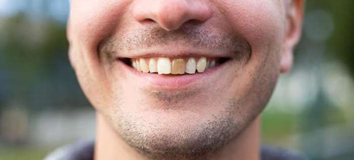 What to do if your crown falls off and the tooth is black