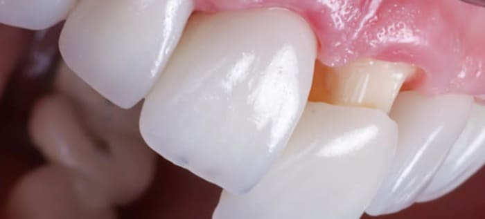 Why does a dental crown fall out