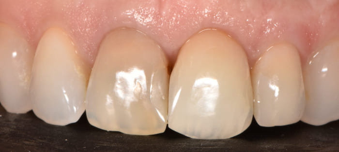 Worried About a Black Tooth Under a Crown Here’s What You Need to Know