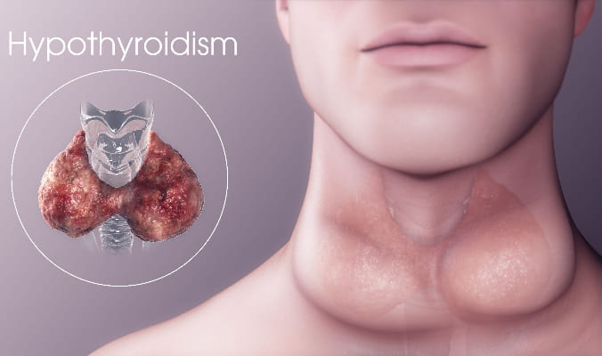 Should you follow the meat diet if you have hypothyroidism